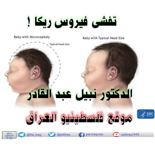 تفشى فيروس زيكا ! الدكتور نبيل عبد القادر ذيب أل ملحم